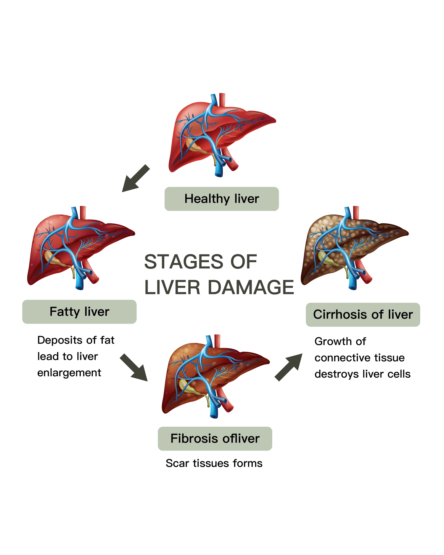 fatty liver