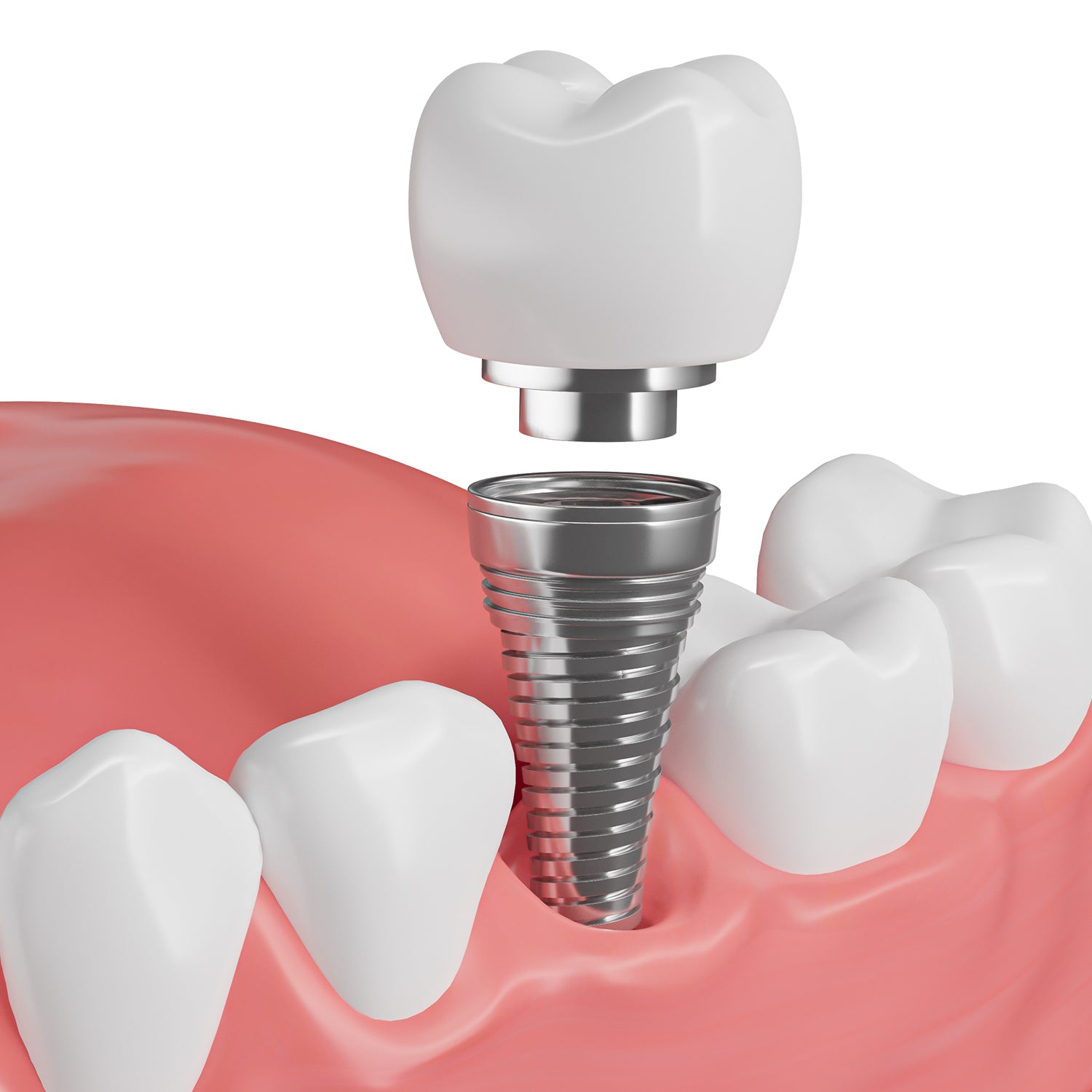 Ideal for Implants