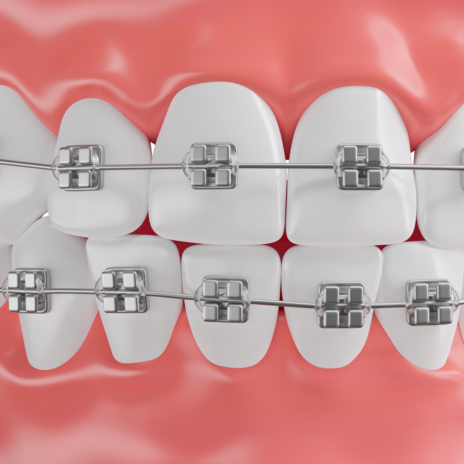 Essential for Braces